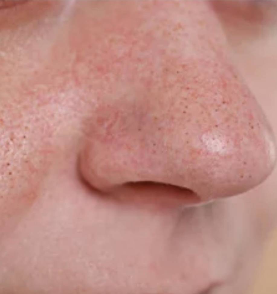 Før og etter bruk av AquaGlow® – renere porer og jevnere hud