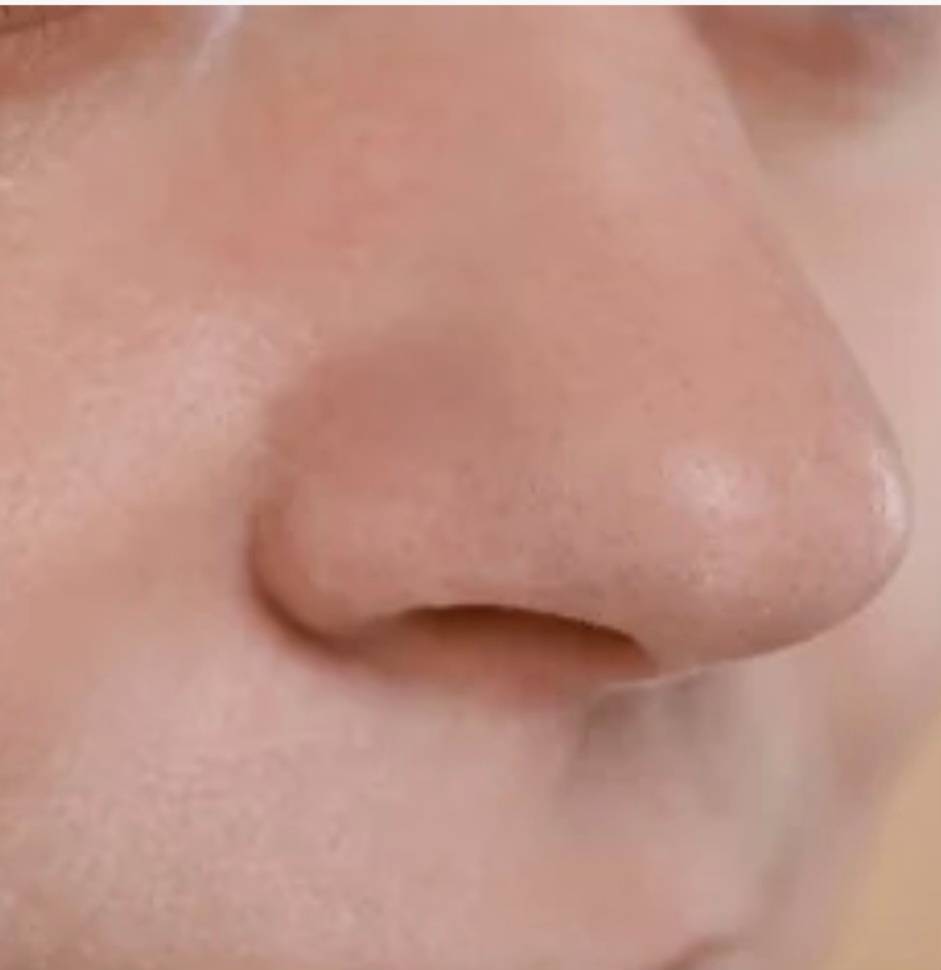 Før og etter bruk av AquaGlow® – renere porer og jevnere hud