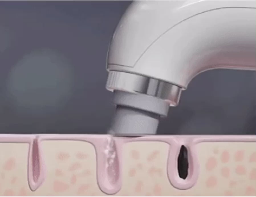 AquaGlow® Hudormfjerner – Blackhead Remover USB